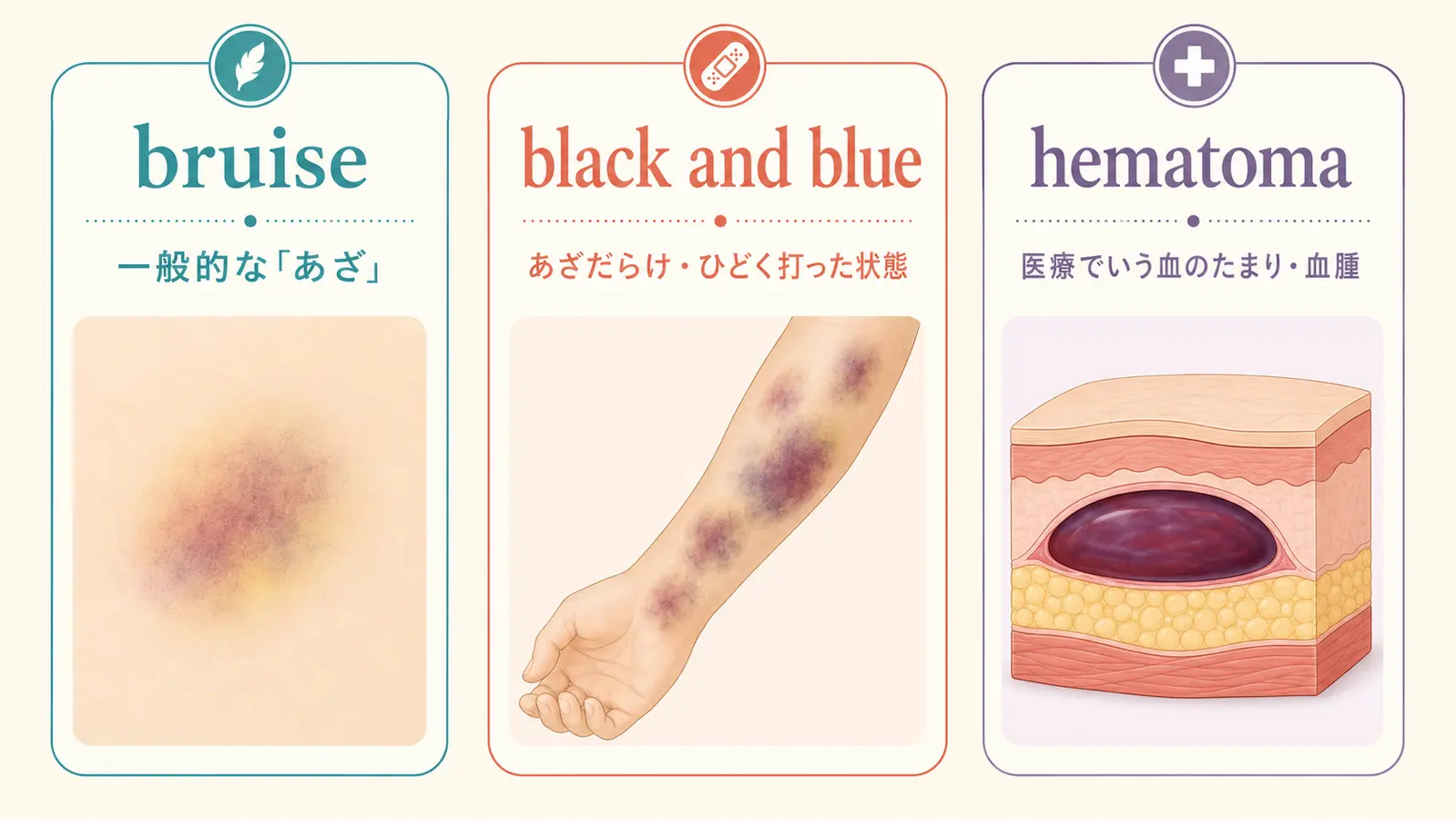 bruiseは一般的なあざ、black and blueはあざだらけ、hematomaは医療でいう血腫という違い