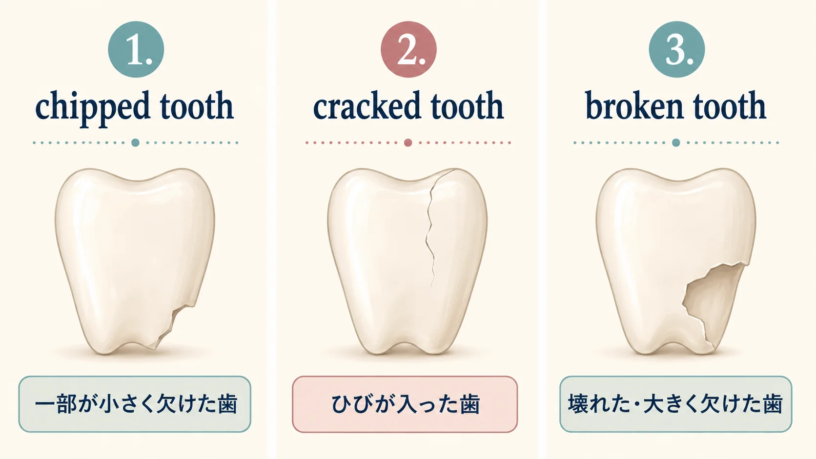 chipped tooth・cracked tooth・broken toothの違いを日本語で比較した図解