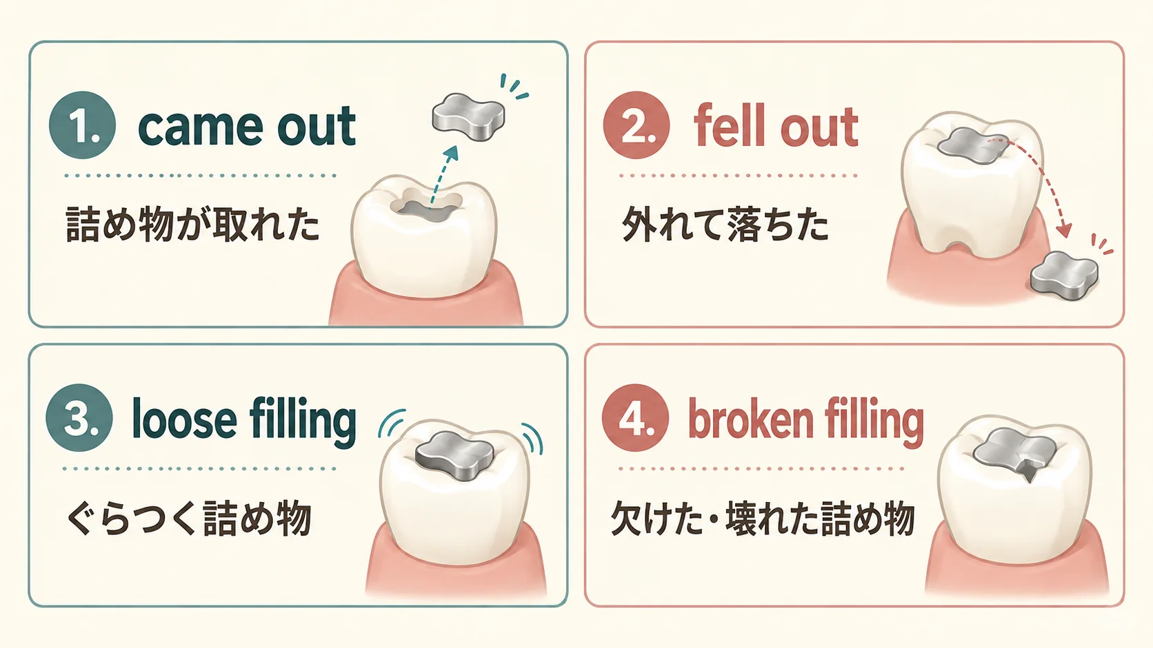 came out・fell out・loose filling・broken fillingの違いを日本語で比較した図解