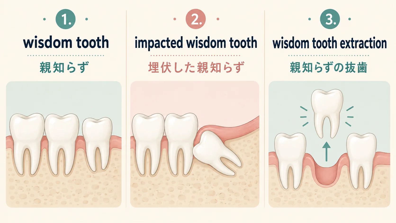wisdom tooth・impacted wisdom tooth・wisdom tooth extractionを日本語で比較した図解